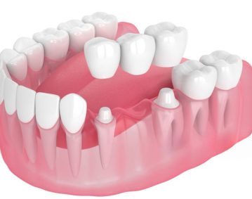 warm_smile_dental_crowns_and_bridges