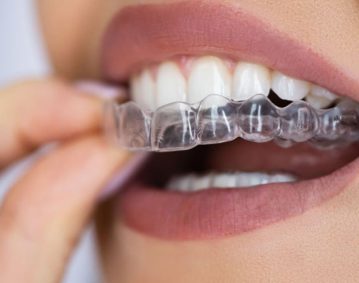 warm_smile_dental_invisalign