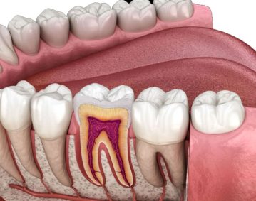 warm_smile_dental_root_canal_treatment