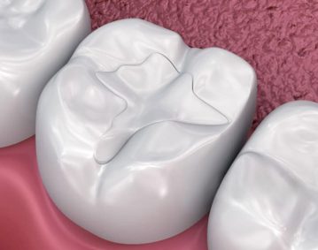 warm_smile_dental_tooth_colored_fillings