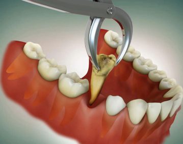 warm_smile_dental_tooth_extraction